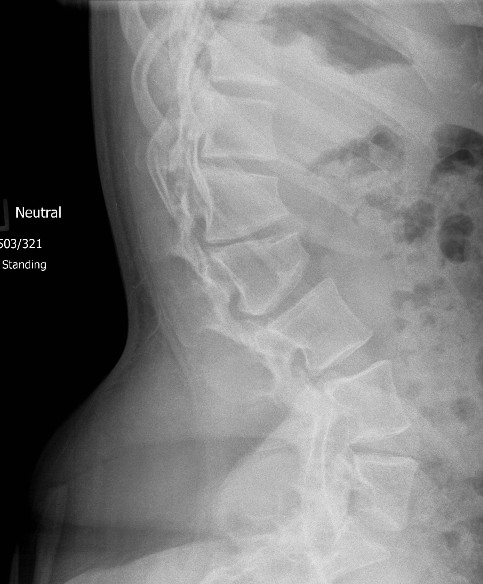 Achondroplasia Increased Lumbar Lordosis Platyspondyly